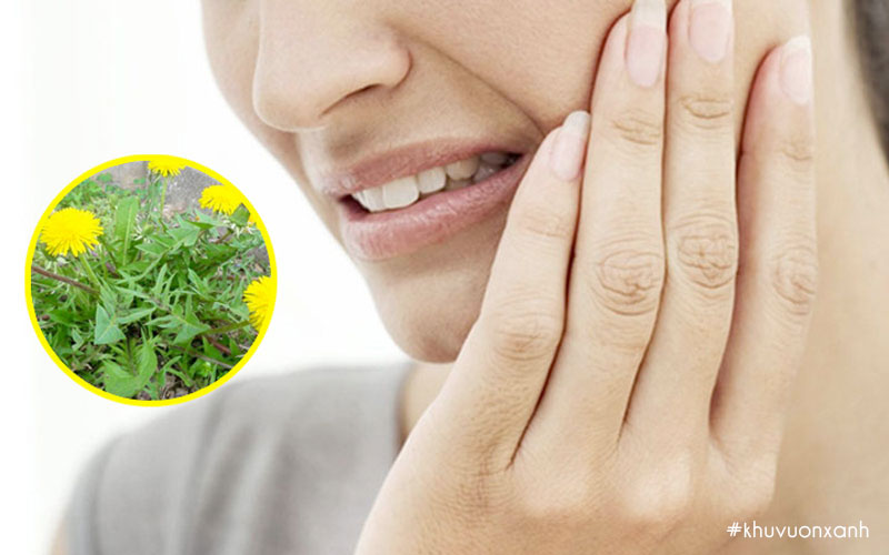 Bồ công anh trị quai bị hiệu quả